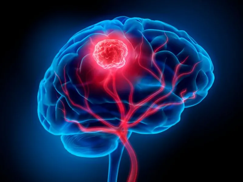 Día Mundial de los Tumores Cerebrales: HPM refuerza su compromiso con la atención integral y tecnología de vanguardia