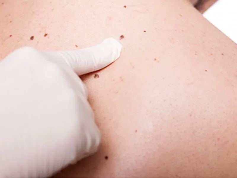 Día Mundial del Melanoma: Protegerse del sol es urgente todo el año