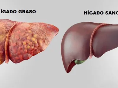 El hígado graso afecta a 1 de cada 3 chilenos: lo que necesitas saber para cuidarte a tiempo