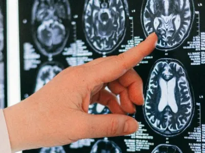 ¿Qué implica para una persona vivir con afasia?