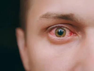 Tus ojos también sufren en otoño